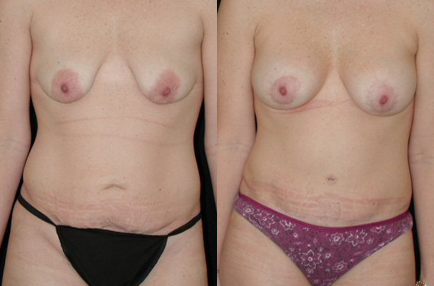 Breast Augmentation/Lift before and after photo by Kirn Plastic Surgery and Skincare Center in Lexington, KY