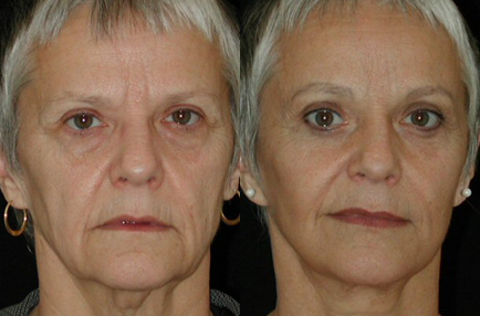 Facelift before and after photo by Kirn Plastic Surgery and Skincare Center in Lexington, KY