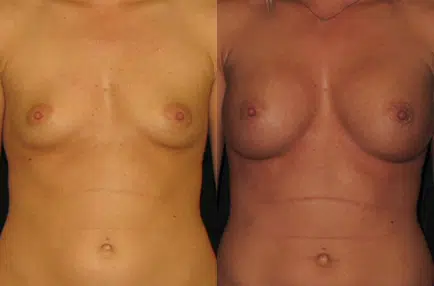 Breast Augmentation before and after photo by Kirn Plastic Surgery and Skincare Center in Lexington, KY