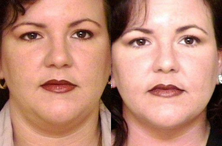 Liposuction before and after photo by Kirn Plastic Surgery and Skincare Center in Lexington, KY