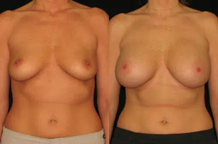 Breast Augmentation before and after photo by Kirn Plastic Surgery and Skincare Center in Lexington, KY