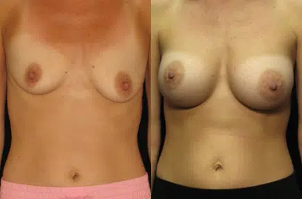 Breast Augmentation before and after photo by Kirn Plastic Surgery and Skincare Center in Lexington, KY