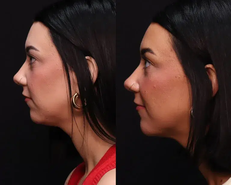 facelift necklift fat grafting before and after photo by kirn plastic surgery and skincare center in lexington ky
