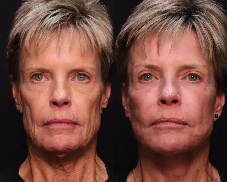 facelift necklift fat grafting before and after photo by kirn plastic surgery and skincare center in lexington ky