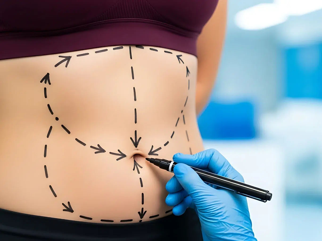 Hand in blue surgical glove drawing mark for plastic surgery on woman abdomen