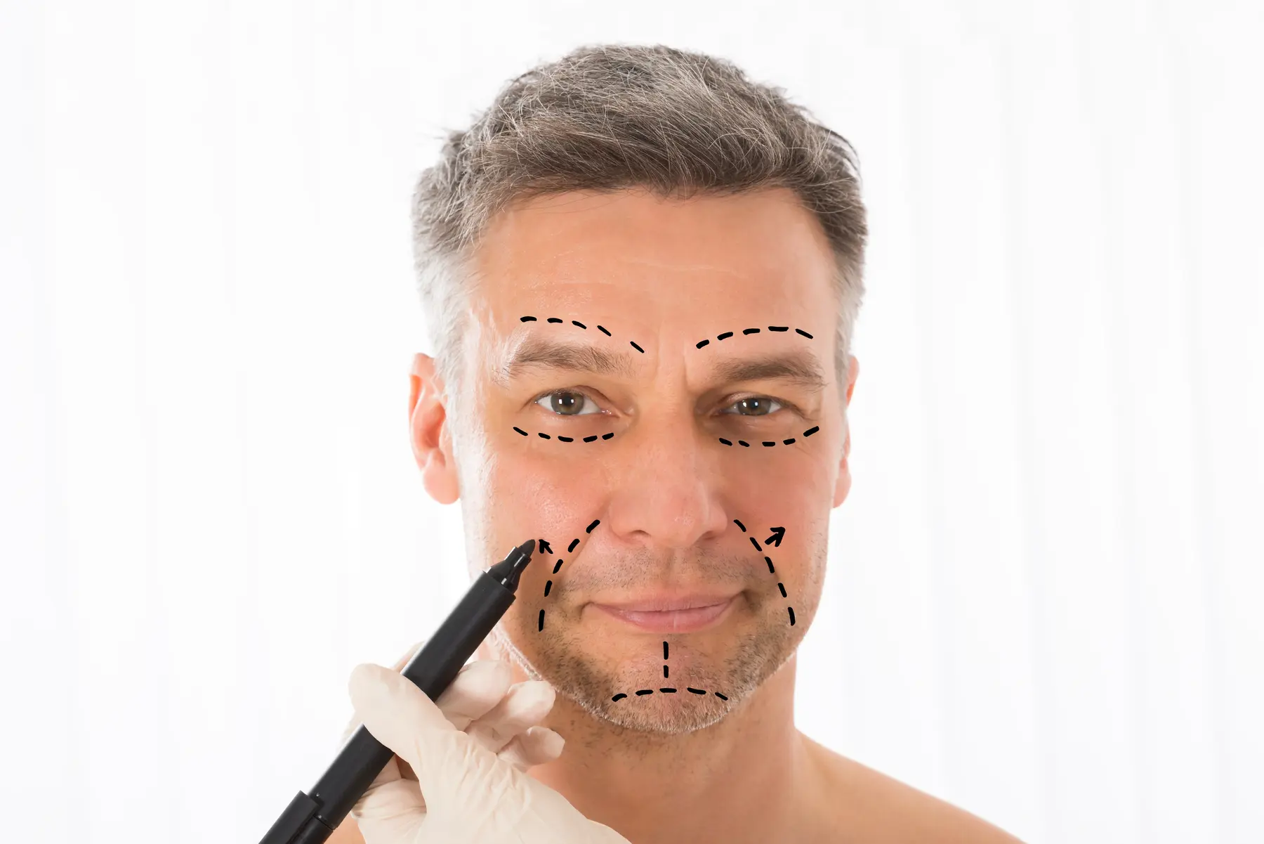 surgeon drawing correction lines on man face